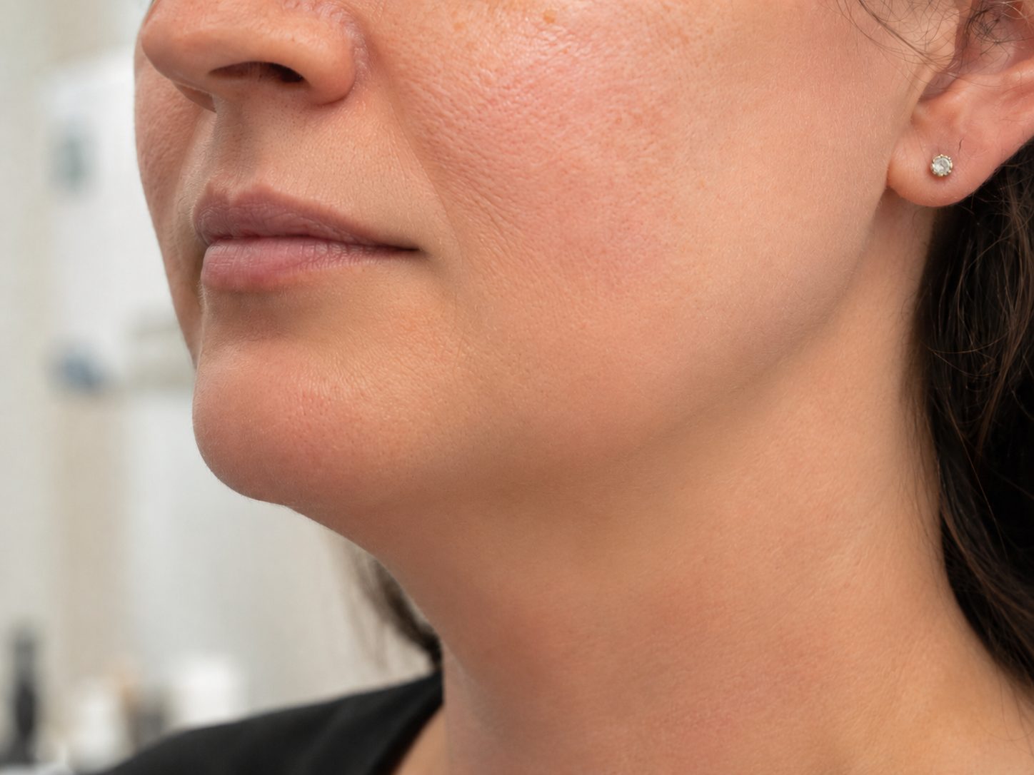 After electrolysis — smooth, hair-free chin and jawline