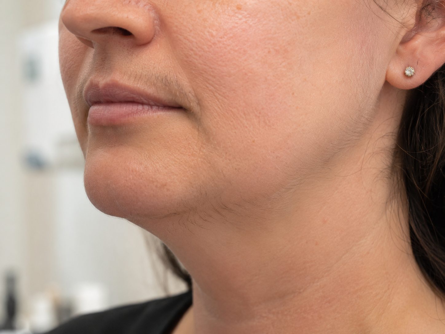 Before electrolysis — unwanted hair on the chin and jawline